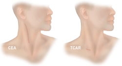 TCAR